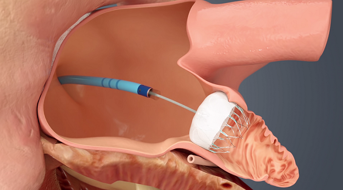 WATCHMAN Device Implantation